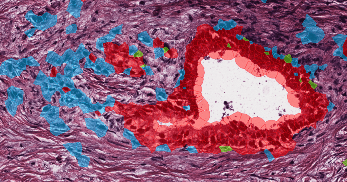 Why one drug isn't enough: AI reveals cancer's secret weapon